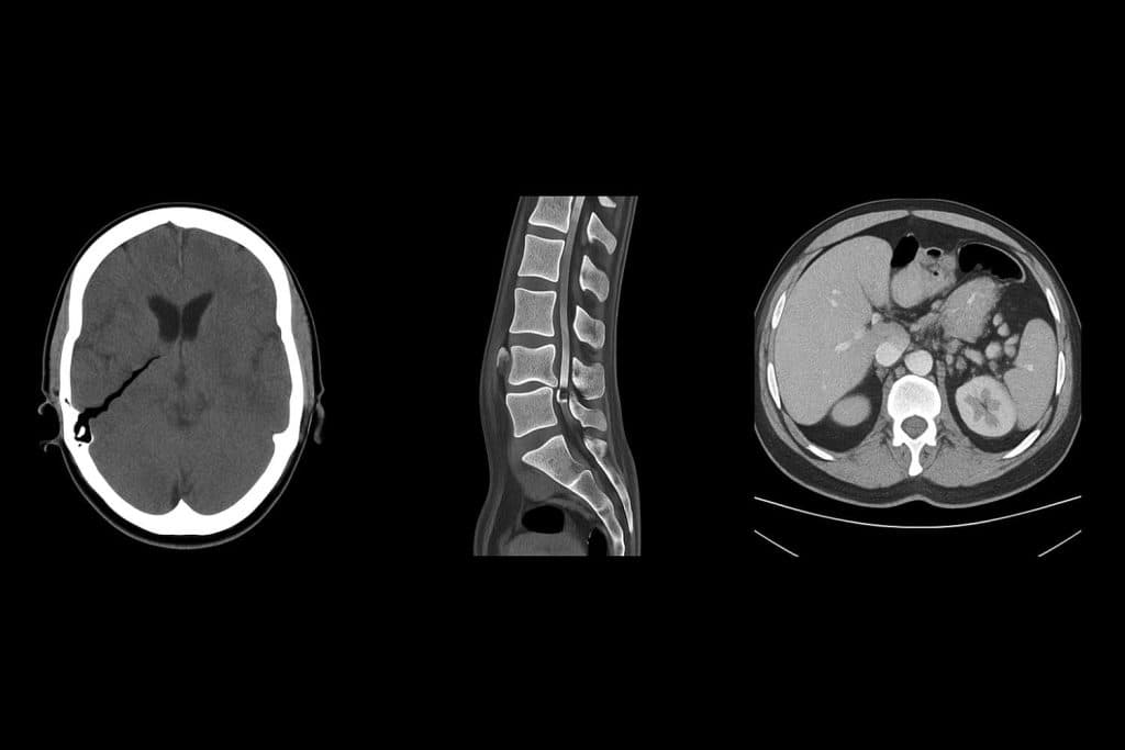 Collage of CT scans: skull hemorrhage, spinal compression fracture, abdominal hematoma