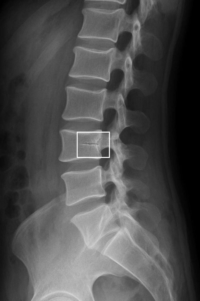 X-ray image showing a vertebral fracture