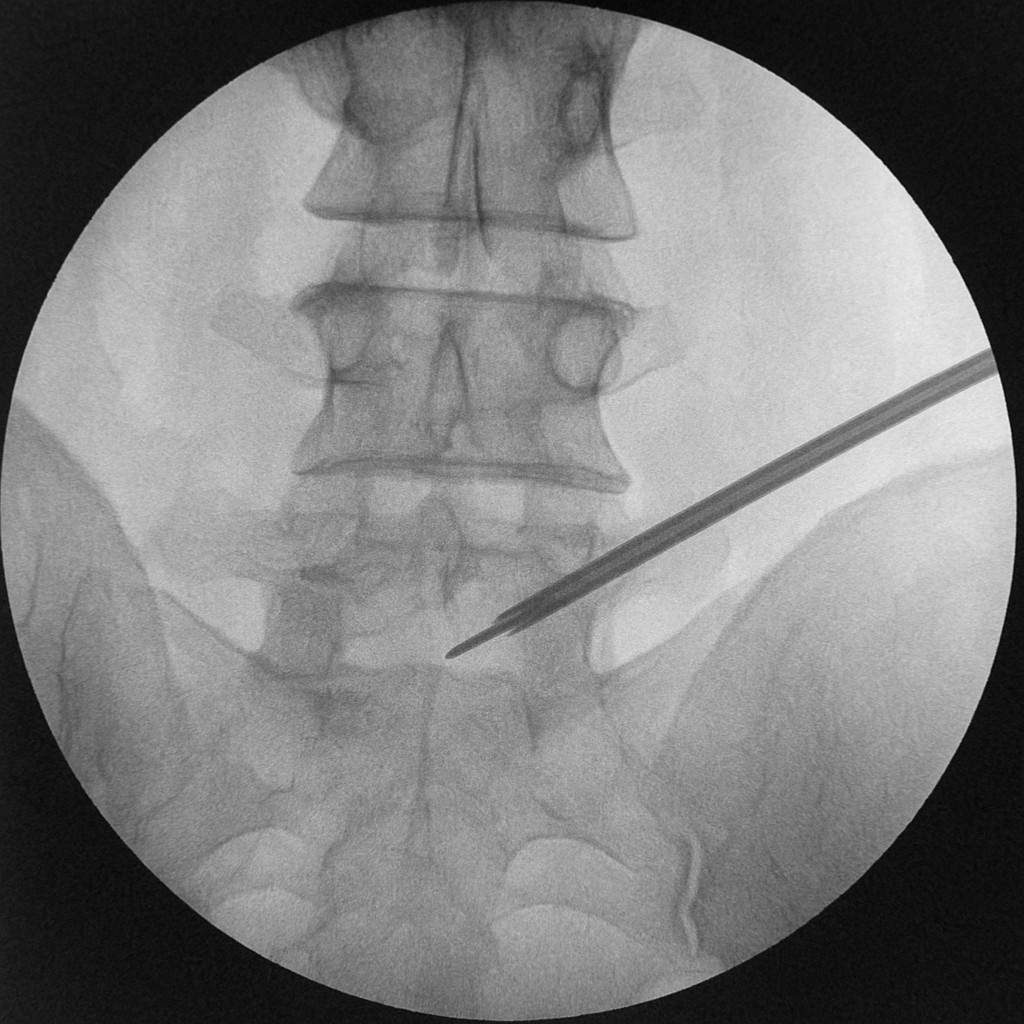 Fluoroscopic image example of needle placement during facet joint injection